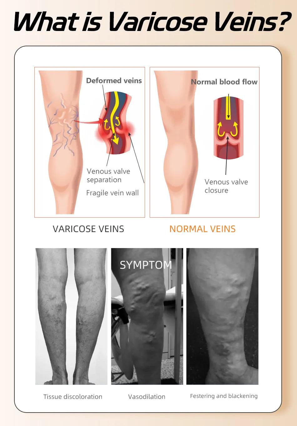 Adenbora Open Toe Compression Stocking: Soulagement élégant et efficace de la douleur liée à la maladie - Adenbora